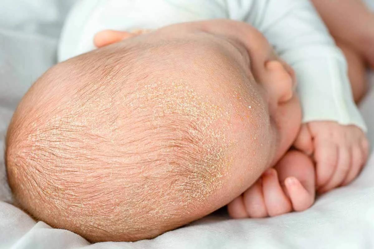 schorf am kopf - Was hilft gegen Schorf auf dem Kopf bei Erwachsenen