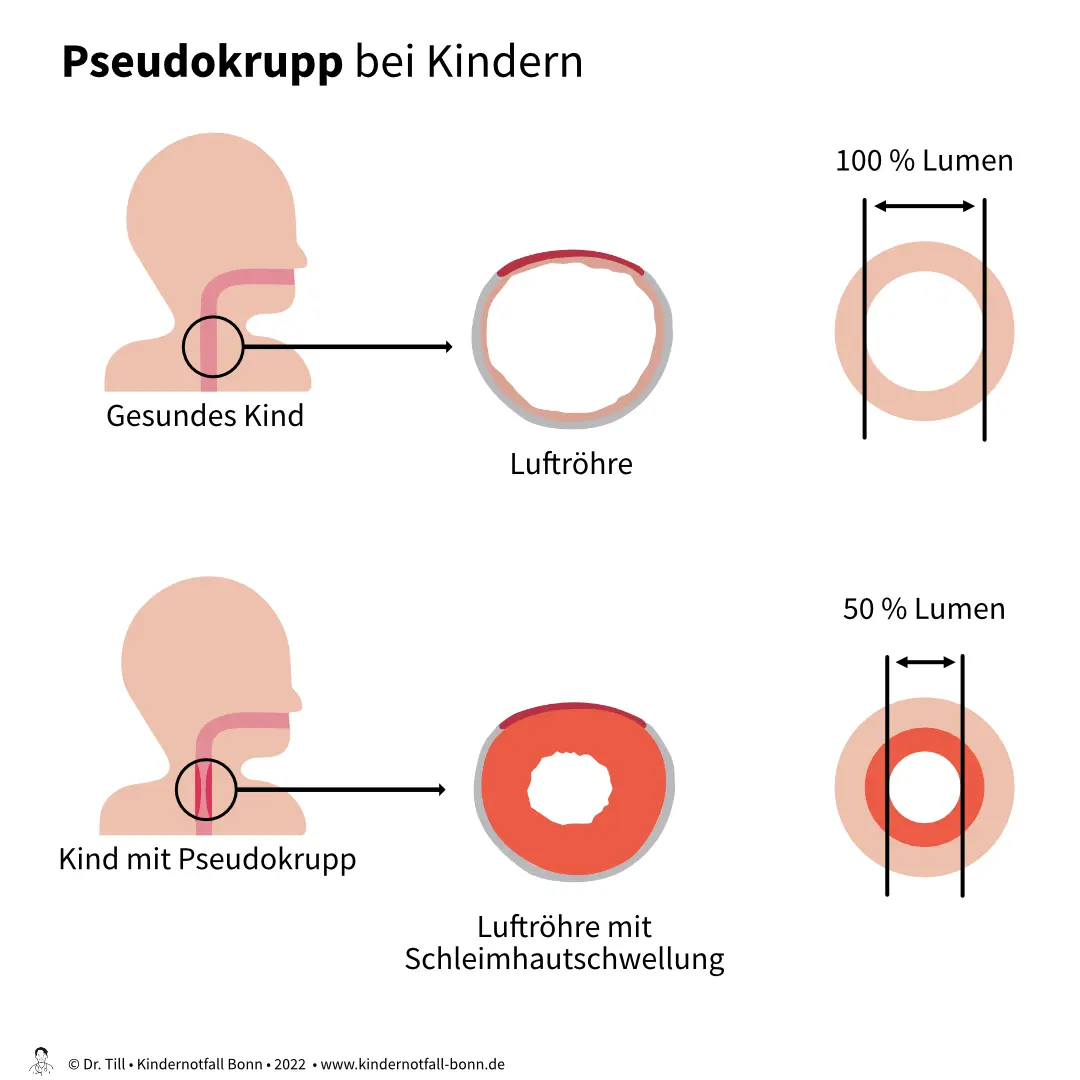 pseudokrupp anfall was tun - Was hilft nachts bei Pseudokrupp