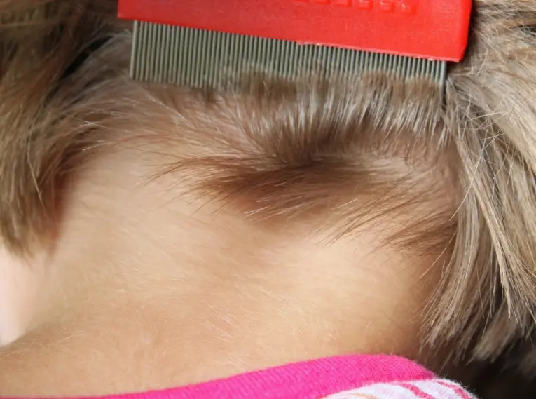 vorbeugung kopfläuse - Was hilft vorbeugend bei Läusen