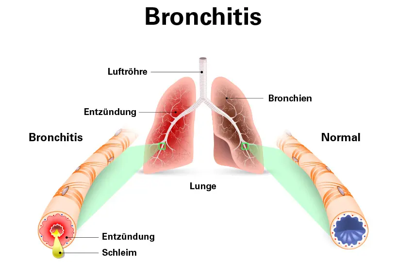 wie hört sich bronchitis an - Was hört man bei Bronchitis