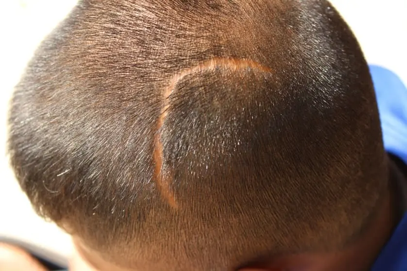 Narbe am Kopf seit Geburt: Ursachen, Symptome und Behandlung - Was ist Aplasia Cutis narbe am kopf seit geburt - Was ist Aplasia Cutis