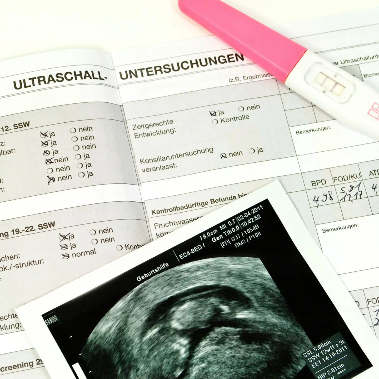 bpd schwangerschaft - Was ist bpd SS