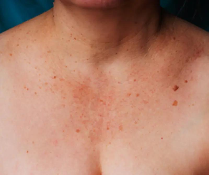 braune flecken brustwarze schwangerschaft - Was ist das braune Um den Nippel