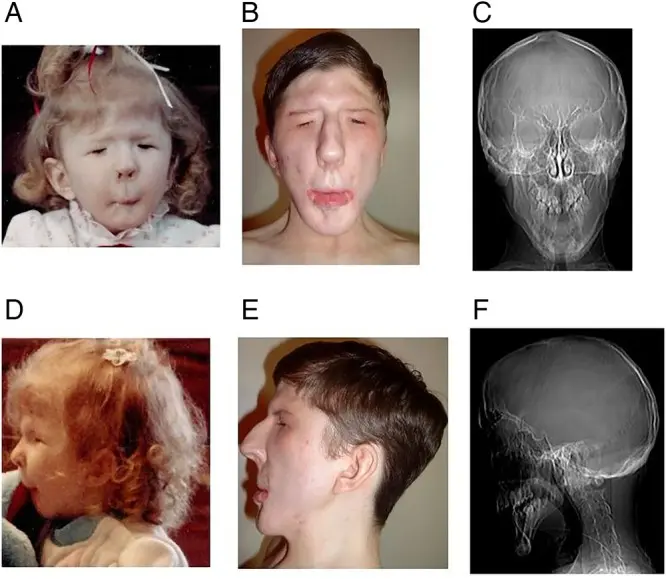 freeman sheldon syndrom schwangerschaft - Was ist das Freeman Sheldon Syndrom