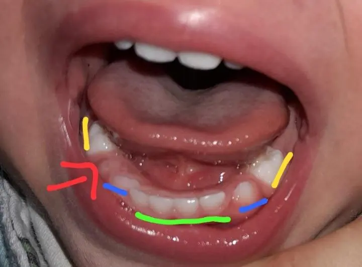 eckzähne durchbruch - Was ist das schmerzhafteste beim Zahnen