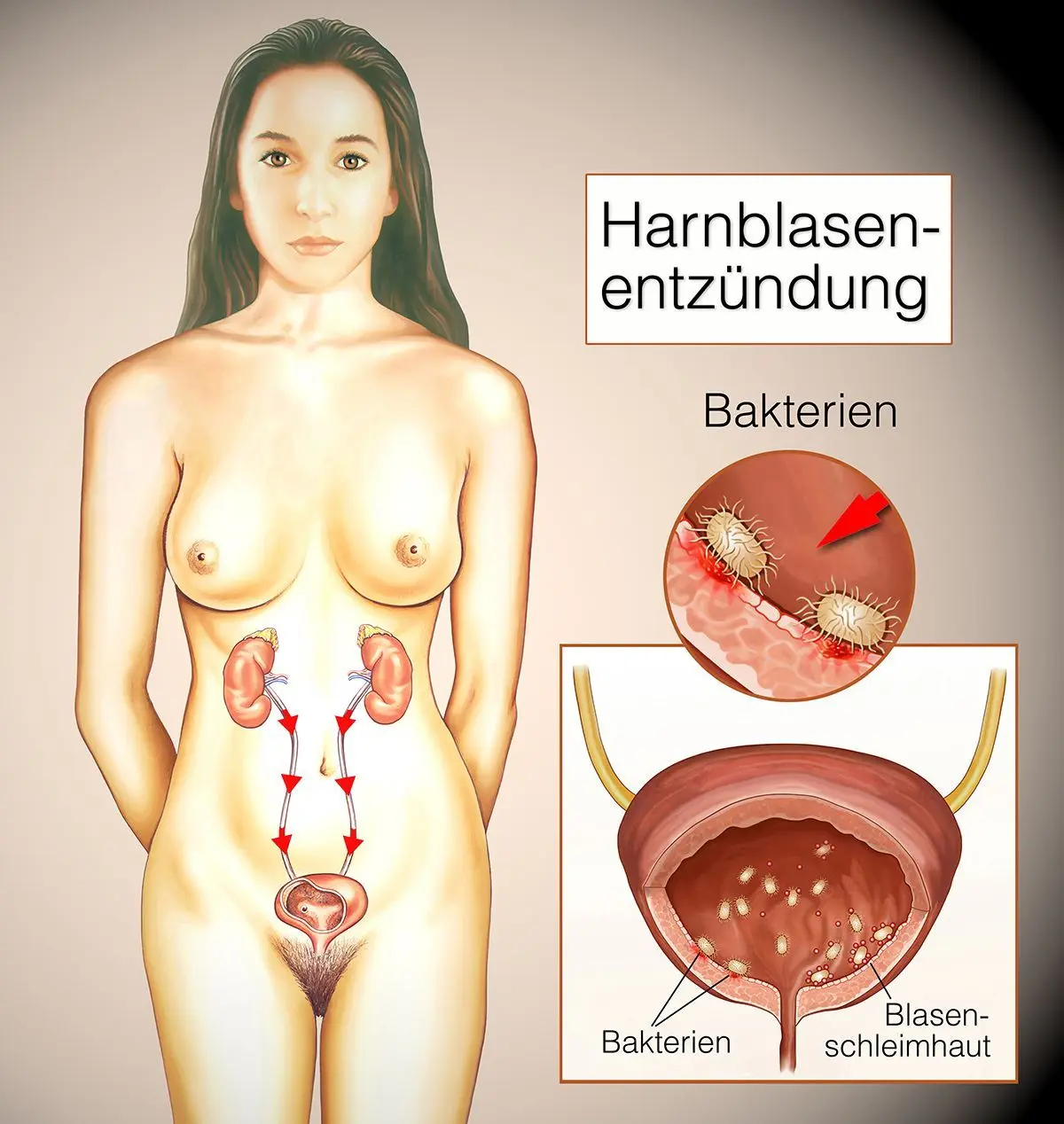 Woran erkennt man eine Blasenentzündung? - Was ist der Unterschied zwischen einem Harnwegsinfekt und einer Blasenentzündung woran erkennt man blasenentzündung - Was ist der Unterschied zwischen einem Harnwegsinfekt und einer Blasenentzündung