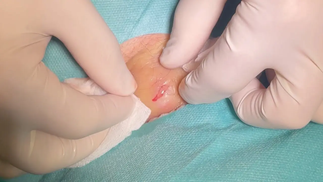 pickel leiste - Was ist der Unterschied zwischen Pickel und Furunkel