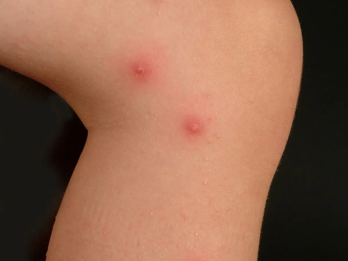 mückenstich blase - Was ist die durchsichtige Flüssigkeit bei Mückenstich