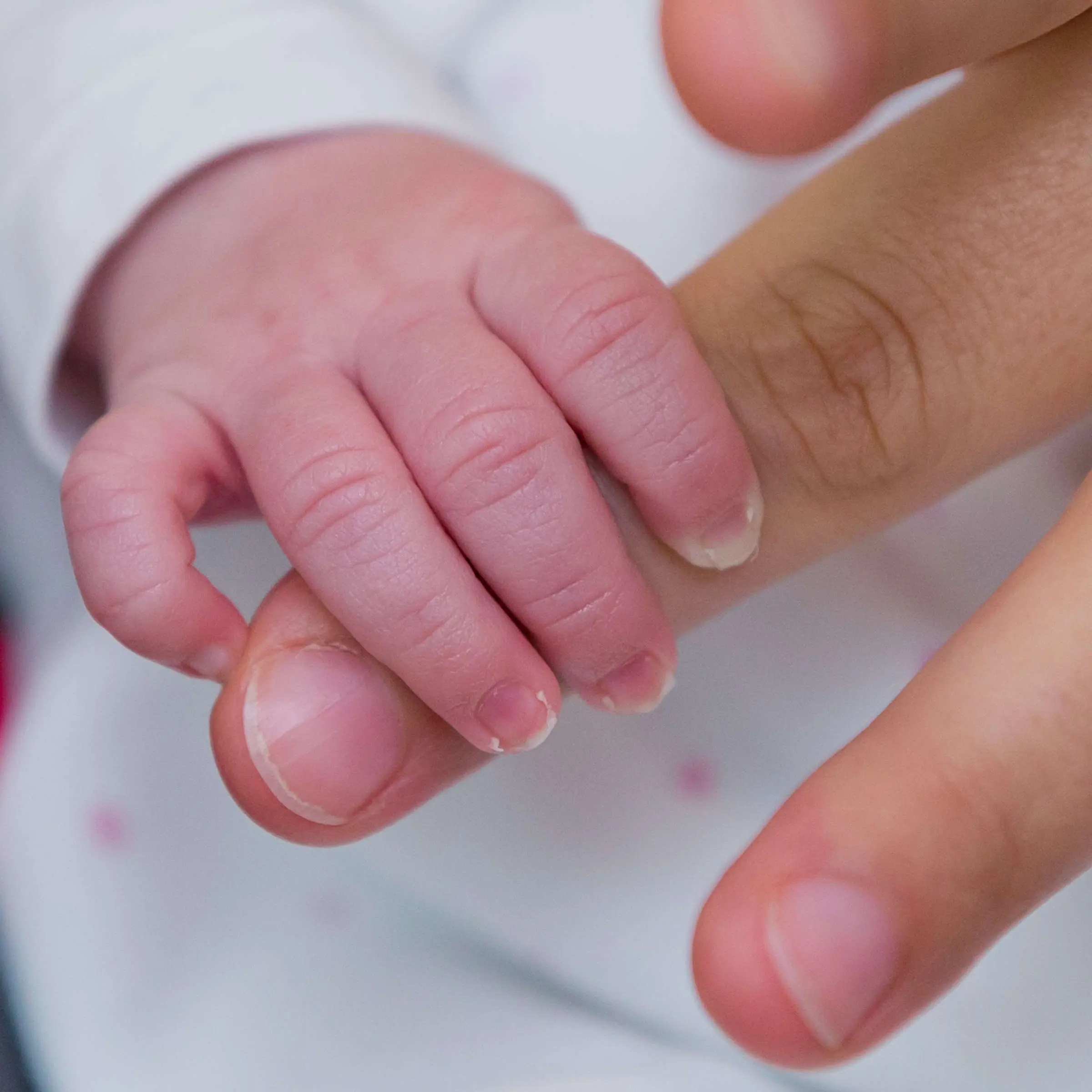 fehlende hand bei geburt - Was ist die häufigste angeborene Fehlbildung