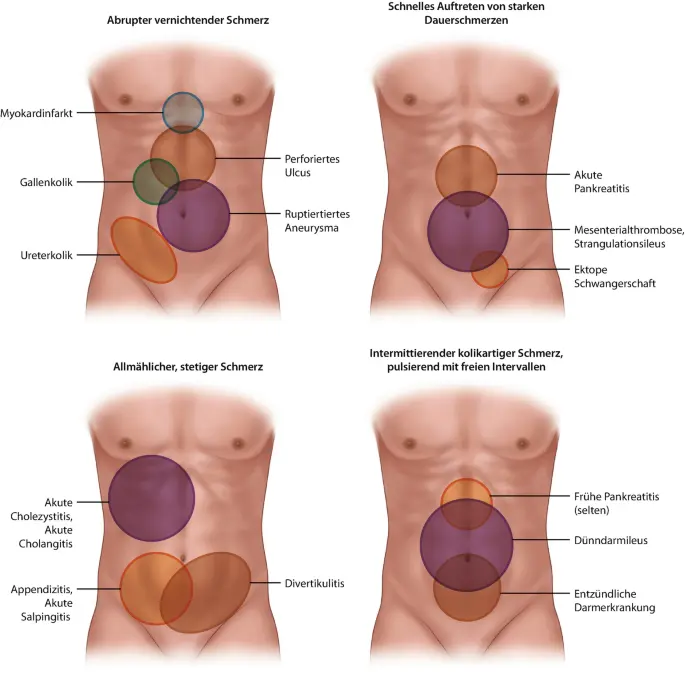 akutes abdomen schwangerschaft - Was ist ein Abdomen Operation
