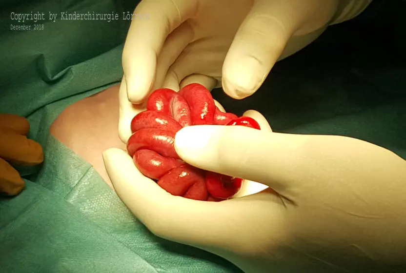 omphalozele überlebenschance - Was ist ein Nabelschnurbruch