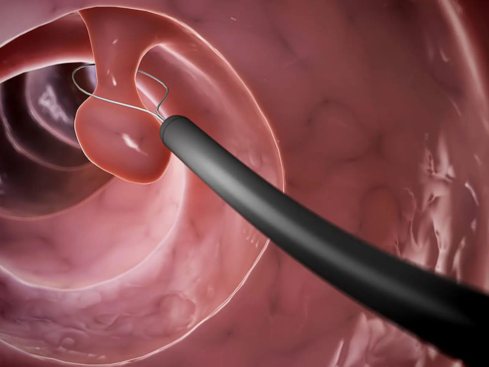 polyp im ohr mensch - Was ist ein Polyp im Ohr
