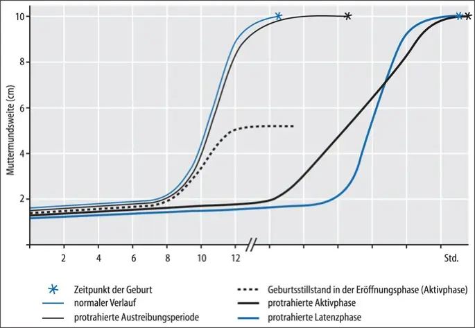 Protrahierte Geburt: Eine umfassende Analyse - Was ist ein protrahierter Verlauf protrahiert geburt - Was ist ein protrahierter Verlauf