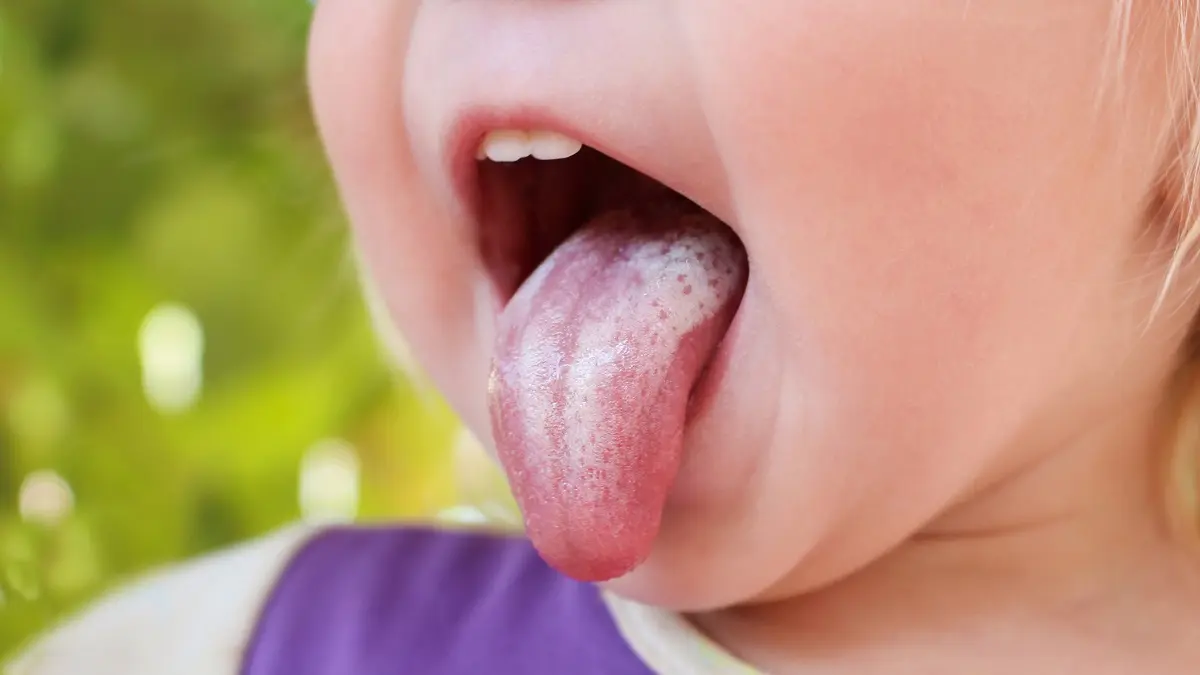 soor kinder - Was ist ein Soor Symptome