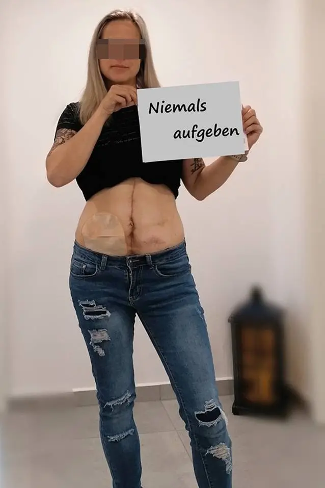 stoma schwangerschaft - Was ist ein Stoma Baby