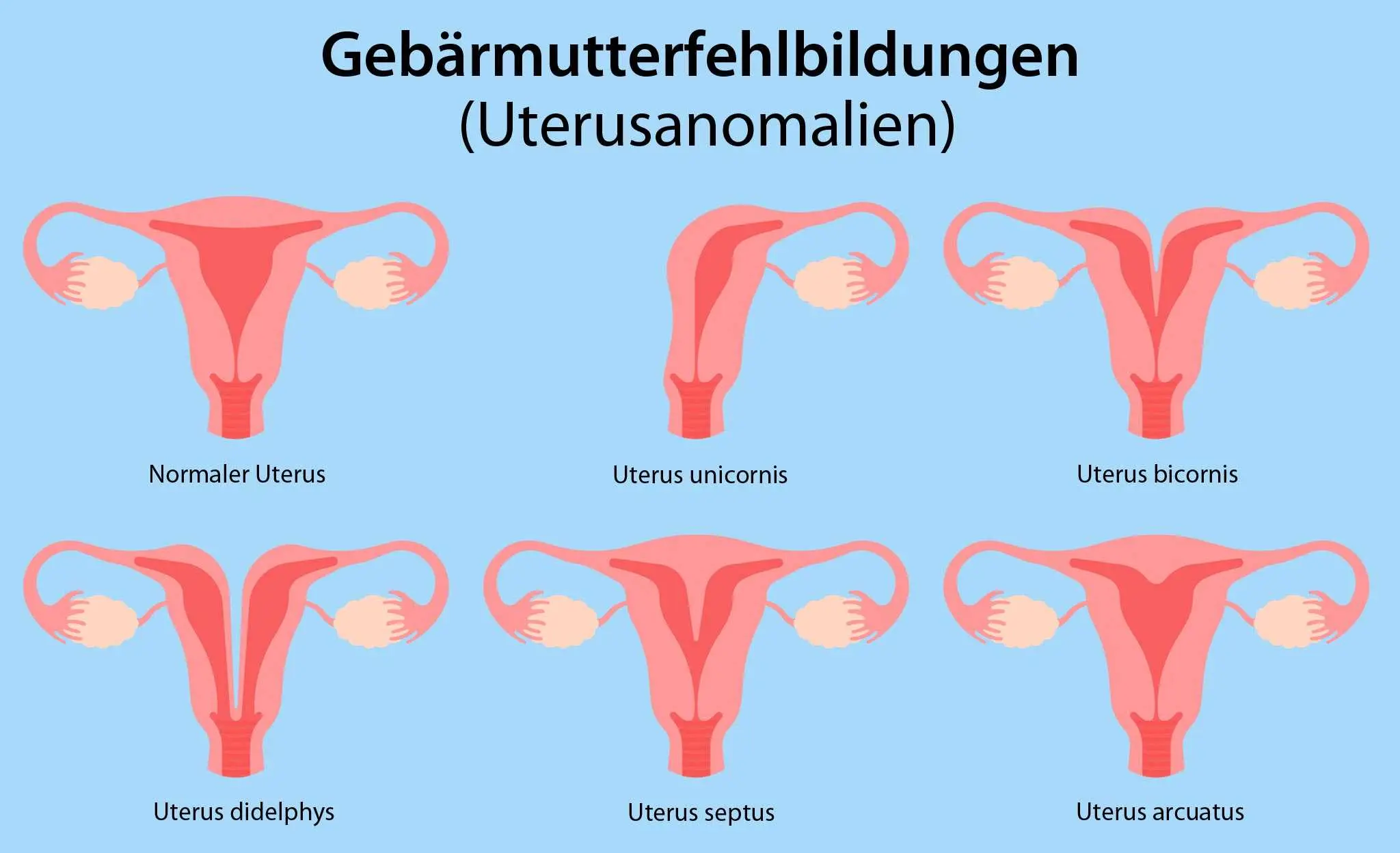 einhorn gebärmutter schwangerschaft - Was ist ein Uterushorn