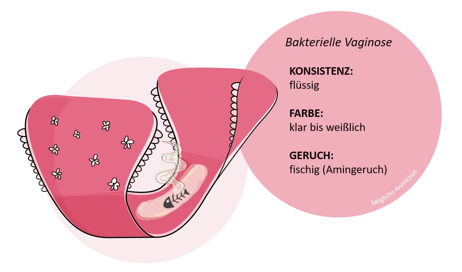 aminkolpitis schwangerschaft - Was ist eine Aminkolpitis