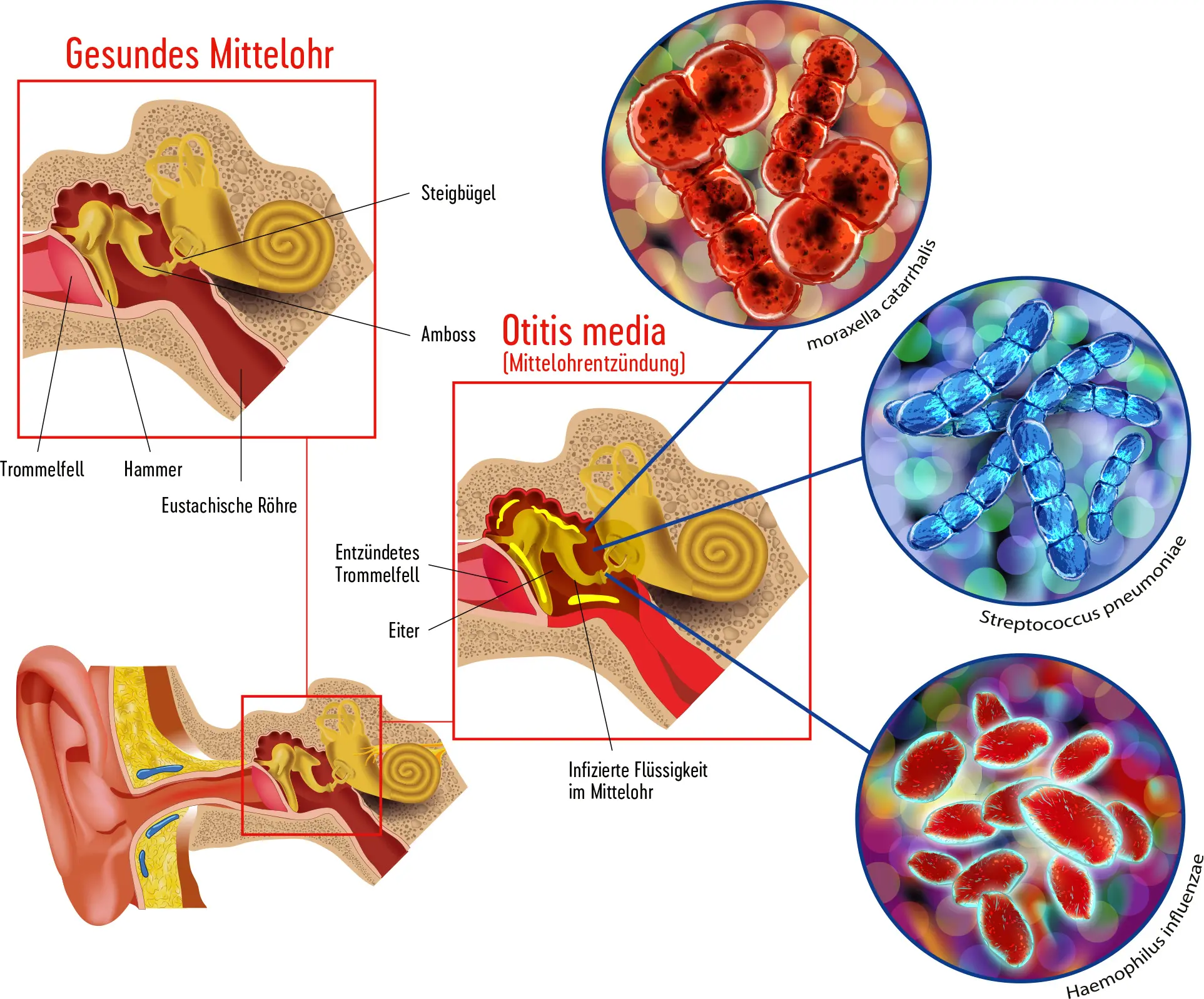 mittelohrentzündung blut - Was ist eine blutige Mittelohrentzündung