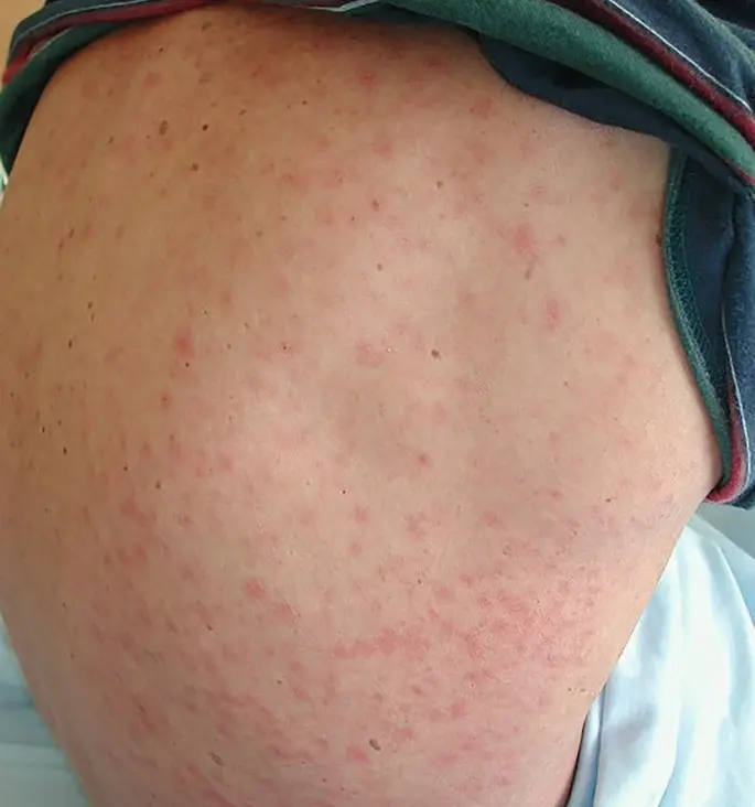 infektiöse mononukleose symptome - Was ist eine infektiöse Mononukleose