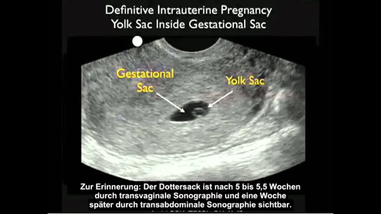 intrauterine schwangerschaft - Was ist eine intrauterinen Schwangerschaft