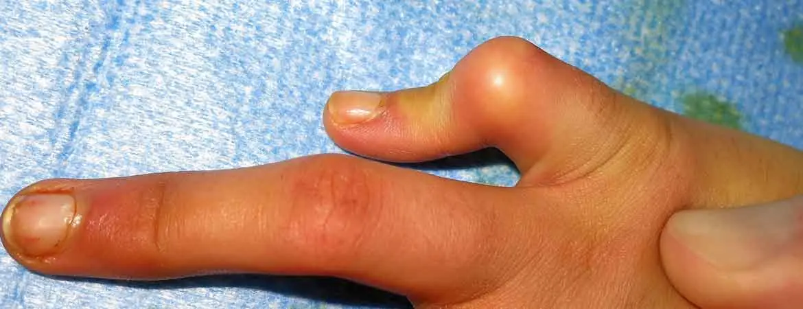 krummer kleiner finger seit geburt - Was ist eine Kamptodaktylie