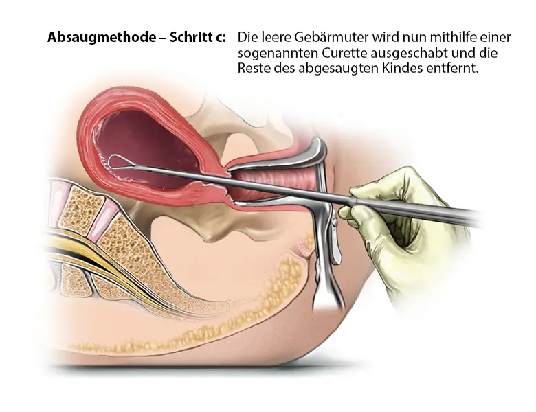 nachkürettage nach geburt - Was ist eine Nachkürettage