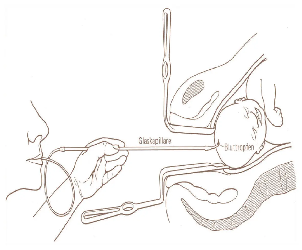 azidose geburt - Was ist eine Perinatale Azidose