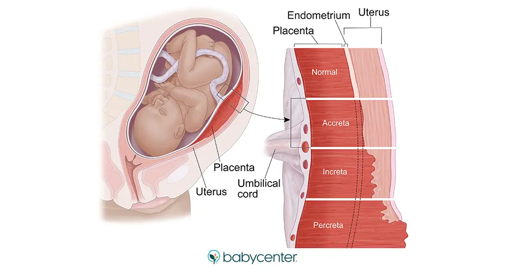 placenta increta accreta - Was ist eine Plazentationsstörung