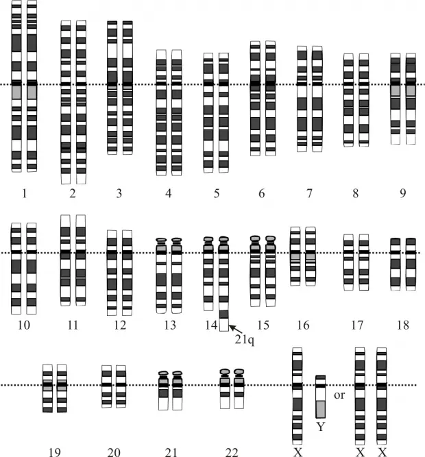 Welche Trisomien gibt es? - Was ist eine Trisomie 9 welche trisomien gibt es - Was ist eine Trisomie 9
