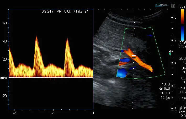 Arteria Uterina Schwangerschaft: Bedeutung und Risiken - Was ist eine Uterina arteria uterina schwangerschaft - Was ist eine Uterina