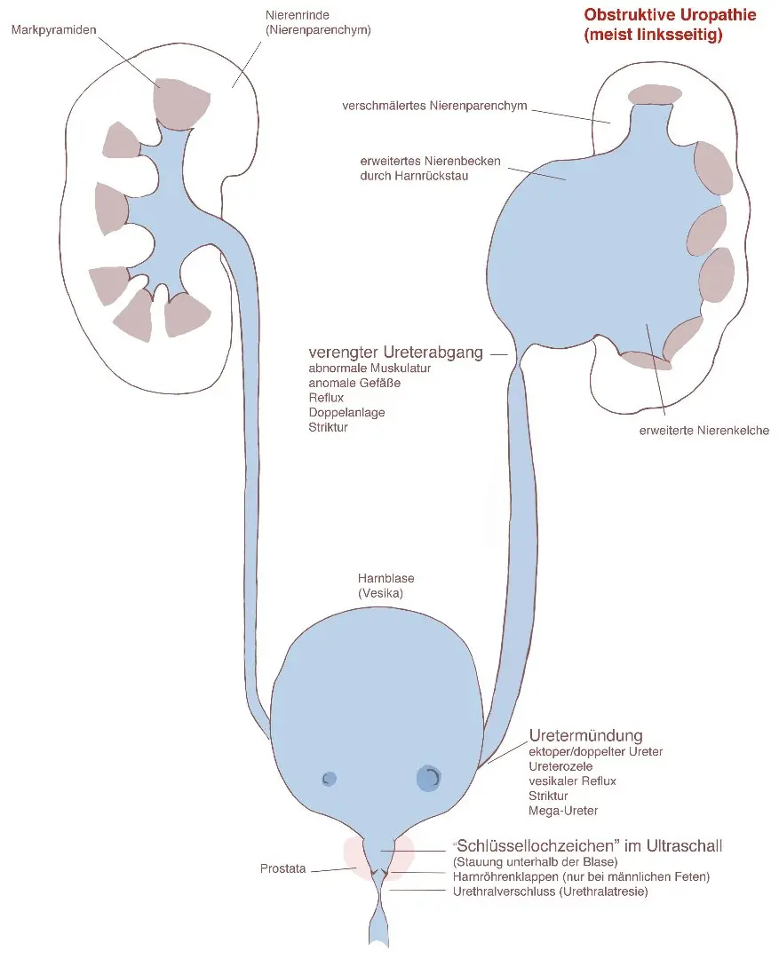 hydronephrose schwangerschaft - Was ist fetale Hydronephrose
