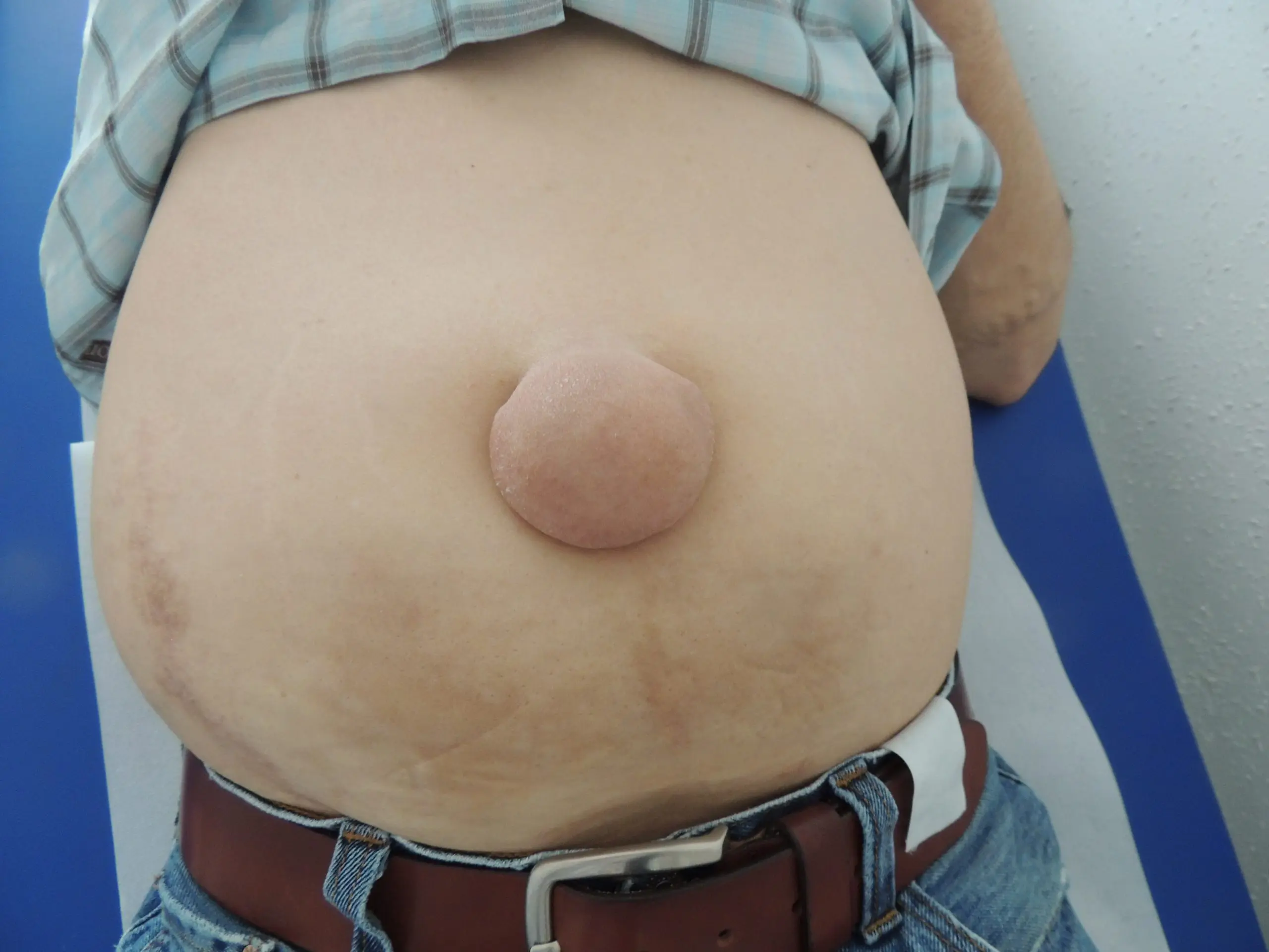 nabelbereich - Was ist genau unter dem Bauchnabel