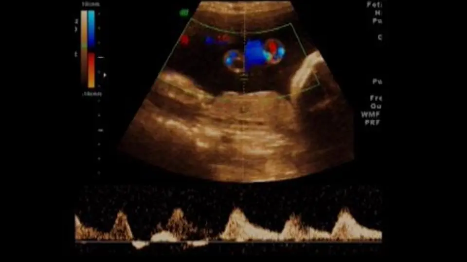 insertio velamentosa beschäftigungsverbot - Was ist Placenta praevia oder Vasa praevia