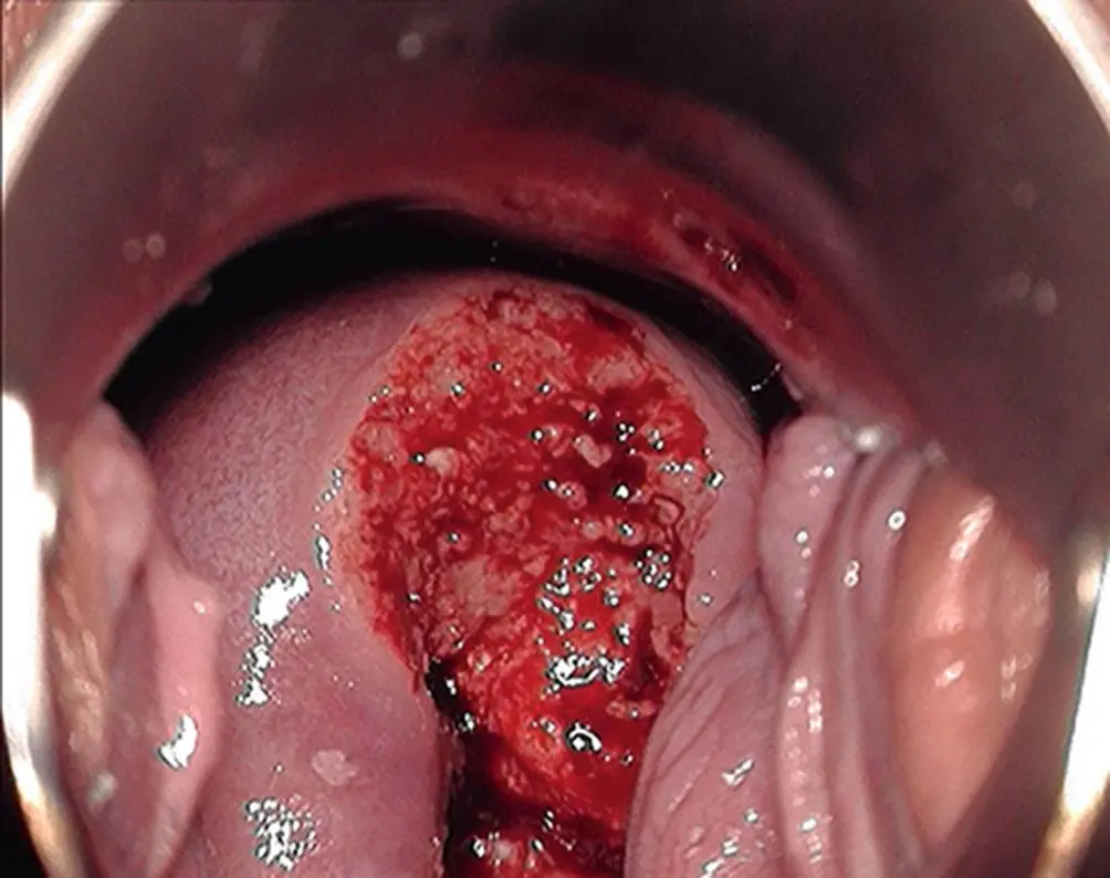 Portioektopie in der Schwangerschaft: Was Sie wissen sollten - Was ist portio bei Schwangerschaft portioektopie schwangerschaft - Was ist portio bei Schwangerschaft