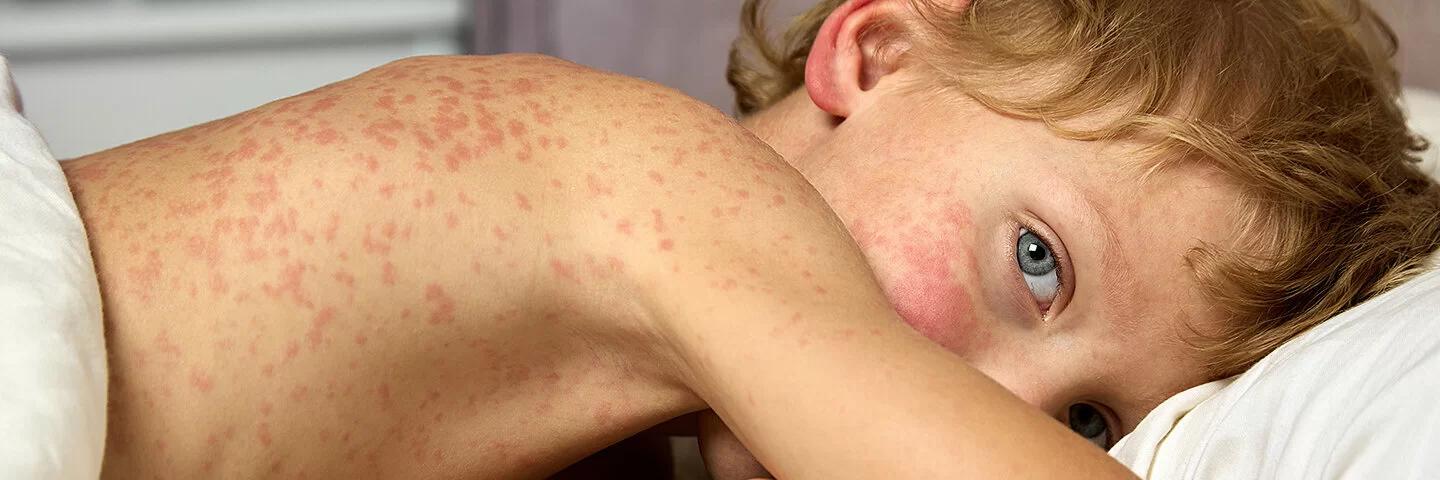 keine röteln immunität in der schwangerschaft - Was ist Röteln Immunität