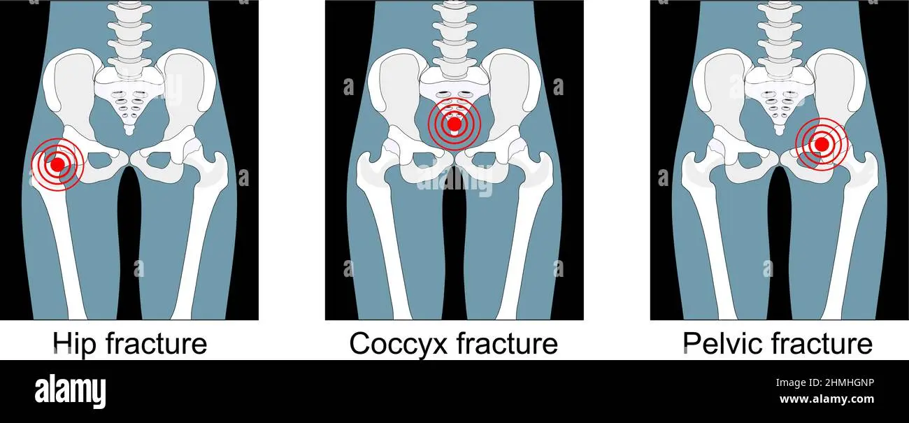 kreuzbeinbruch geburt - Was ist wenn das Kreuzbein gebrochen ist