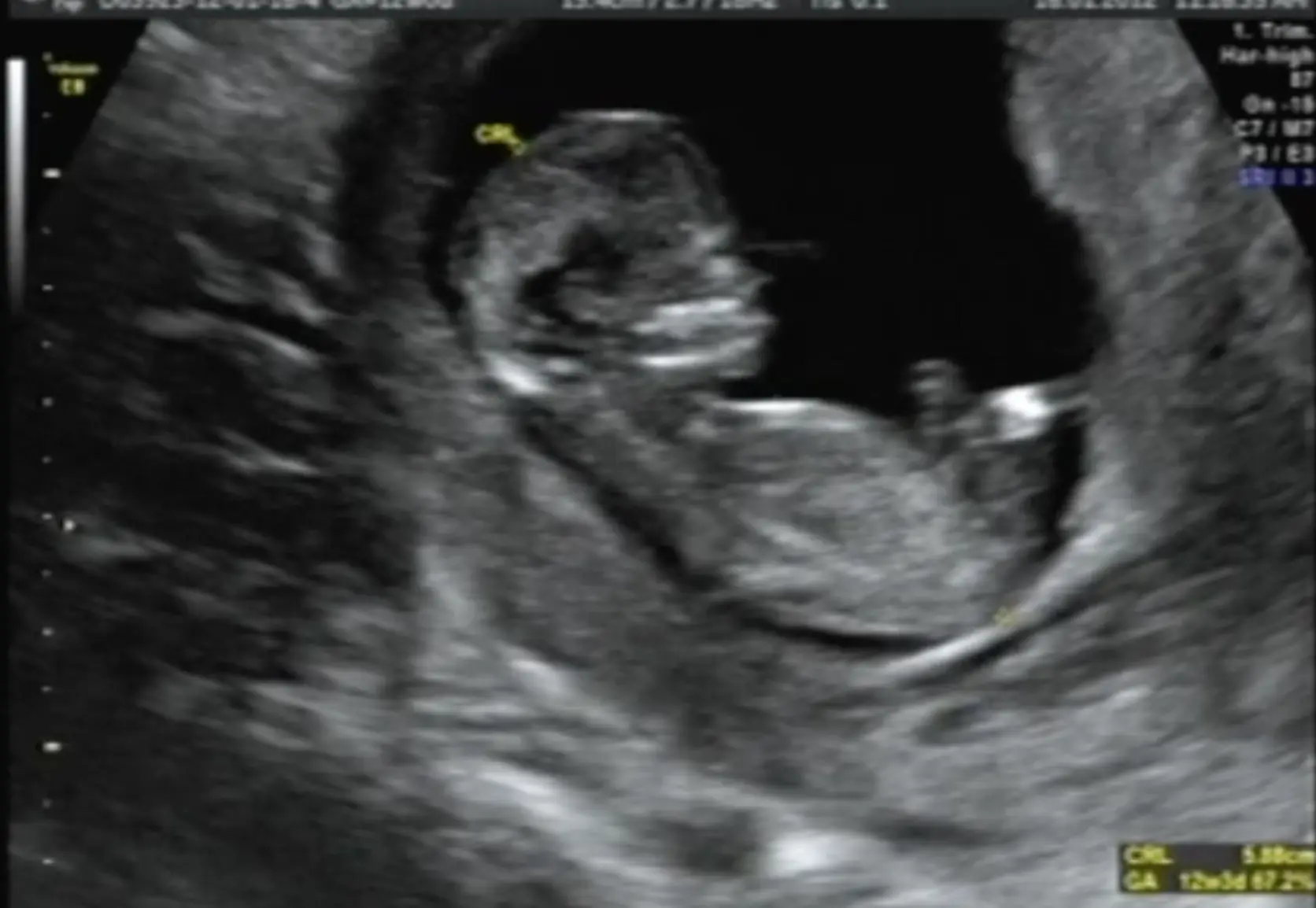 schwangerschaft niesen schmerzen - Was ist wenn das Niesen weh tut