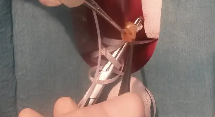 singuläre nabelschnurarterie geburt einleiten - Was ist wenn in der Nabelschnur nur eine Arterie hat