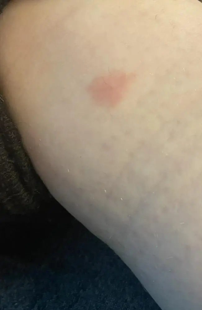 bremsenstich schwangerschaft - Was kann bei einem Bremsenstich passieren