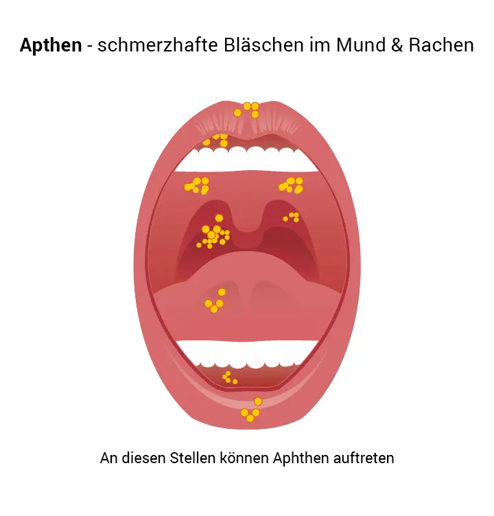 aphten im mund schwangerschaft - Was kann ich gegen Aphten im Mund tun
