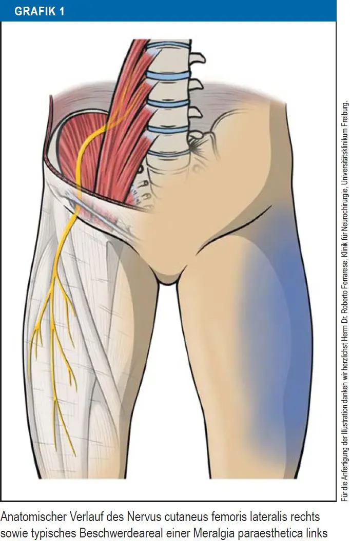 meralgia paraesthetica schwangerschaft - Was kann ich selber tun bei Meralgia paraesthetica
