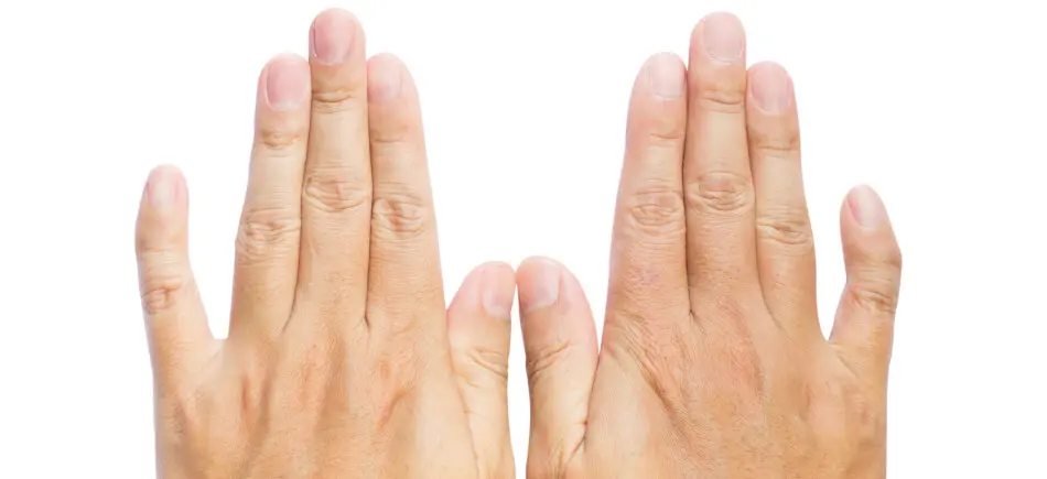 kleiner finger krumm seit geburt - Was kann man gegen einen schiefen Finger machen