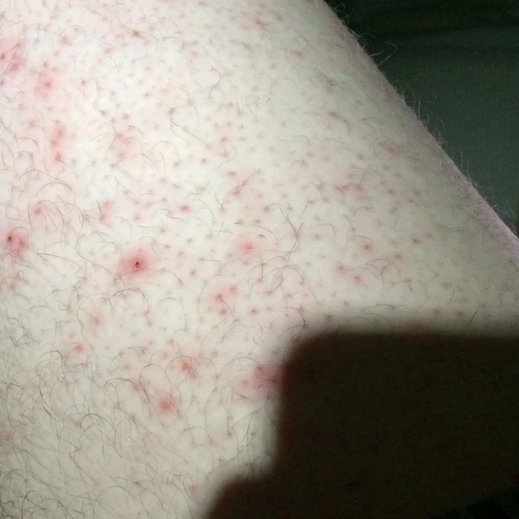 kleine pickel oberschenkel - Was kann man gegen Keratosis pilaris tun