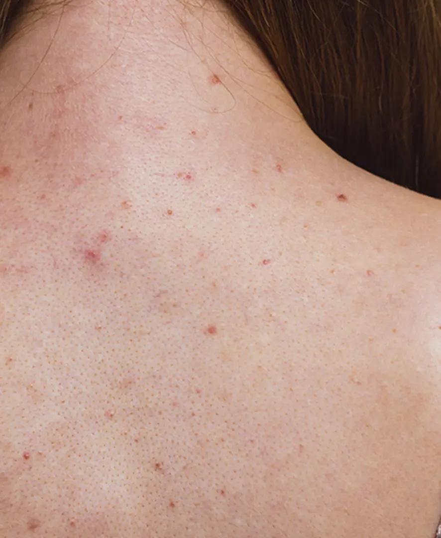 rote pickel rücken - Was kann man gegen Pickel auf dem Rücken tun