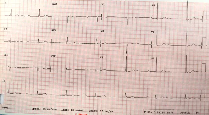 ekg schwangerschaft - Was kann man mit EKG feststellen