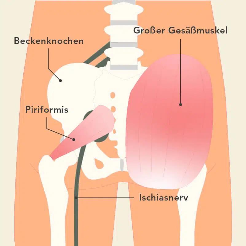 ischiasschmerzen ursachen - Was kann man tun gegen Ischiasschmerzen