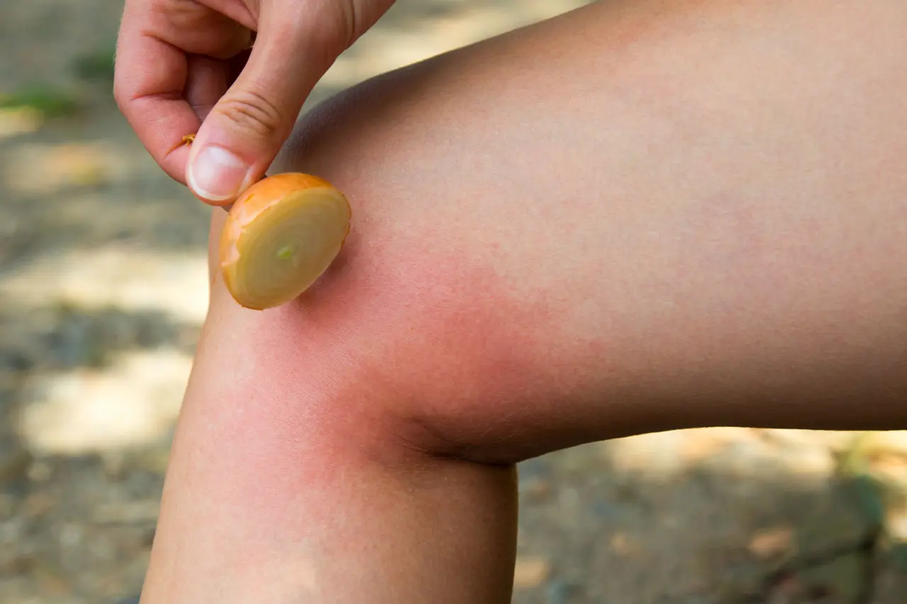 Bienenstich in der Schwangerschaft: Was Sie wissen sollten - Was kann nach einem Bienenstich passieren bienenstich schwangerschaft - Was kann nach einem Bienenstich passieren