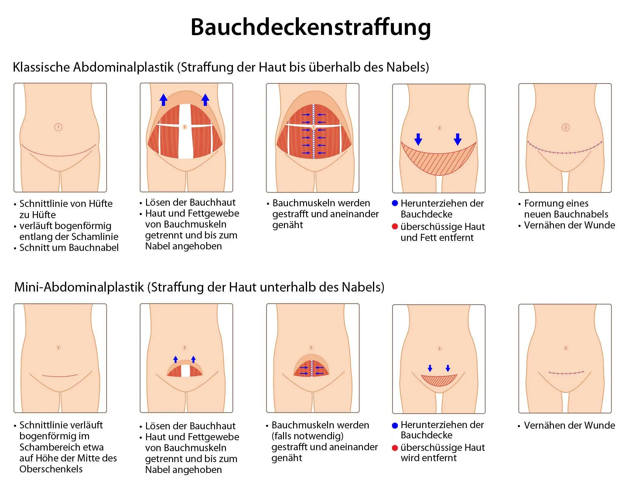 fettschürze nach schwangerschaft krankenkasse - Was kostet eine Entfernung einer Fettschürze