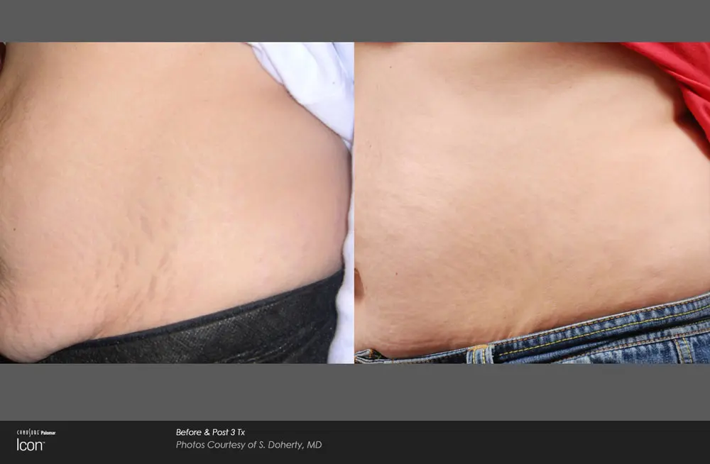 schwangerschaft dehnungsstreifen lasern vorher nachher - Was kostet es Dehnungsstreifen Weg zu lasern