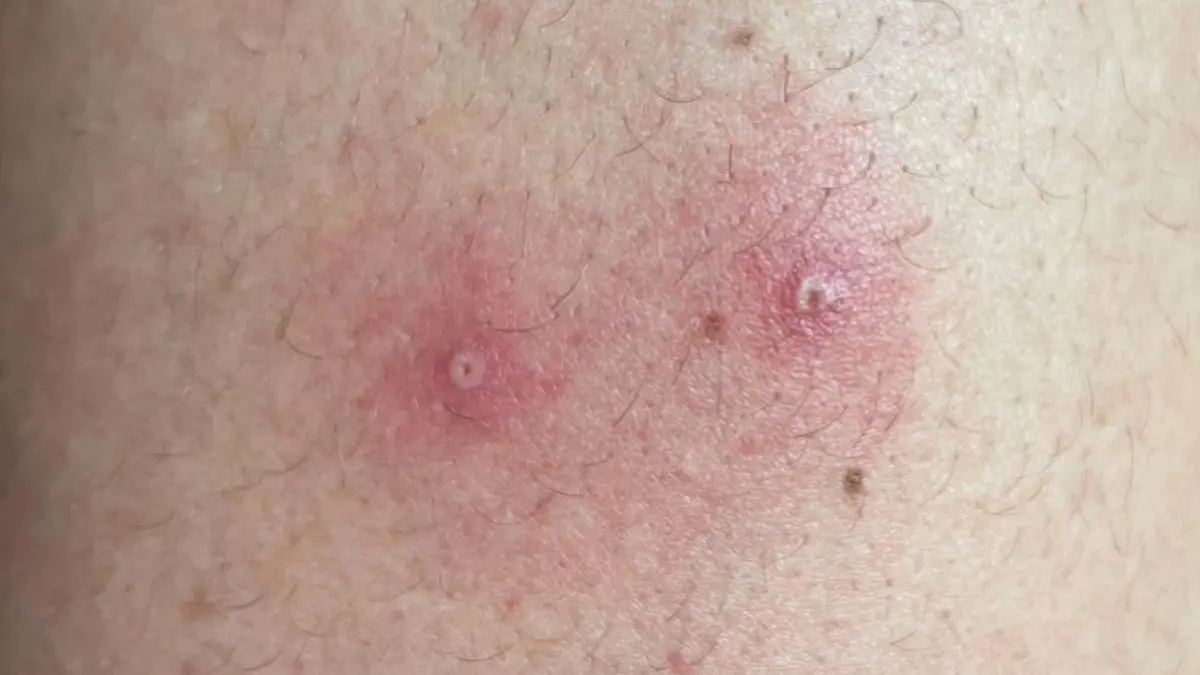 fieber pustel - Was machen bei pustel